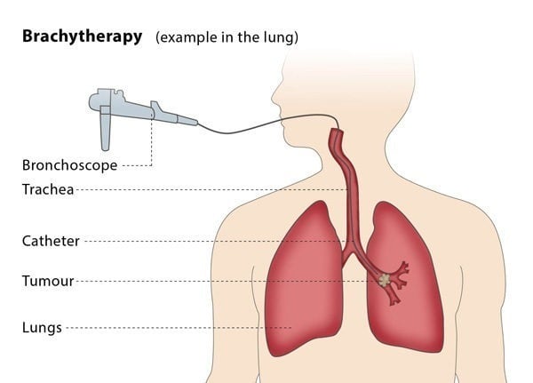 brachytherapy